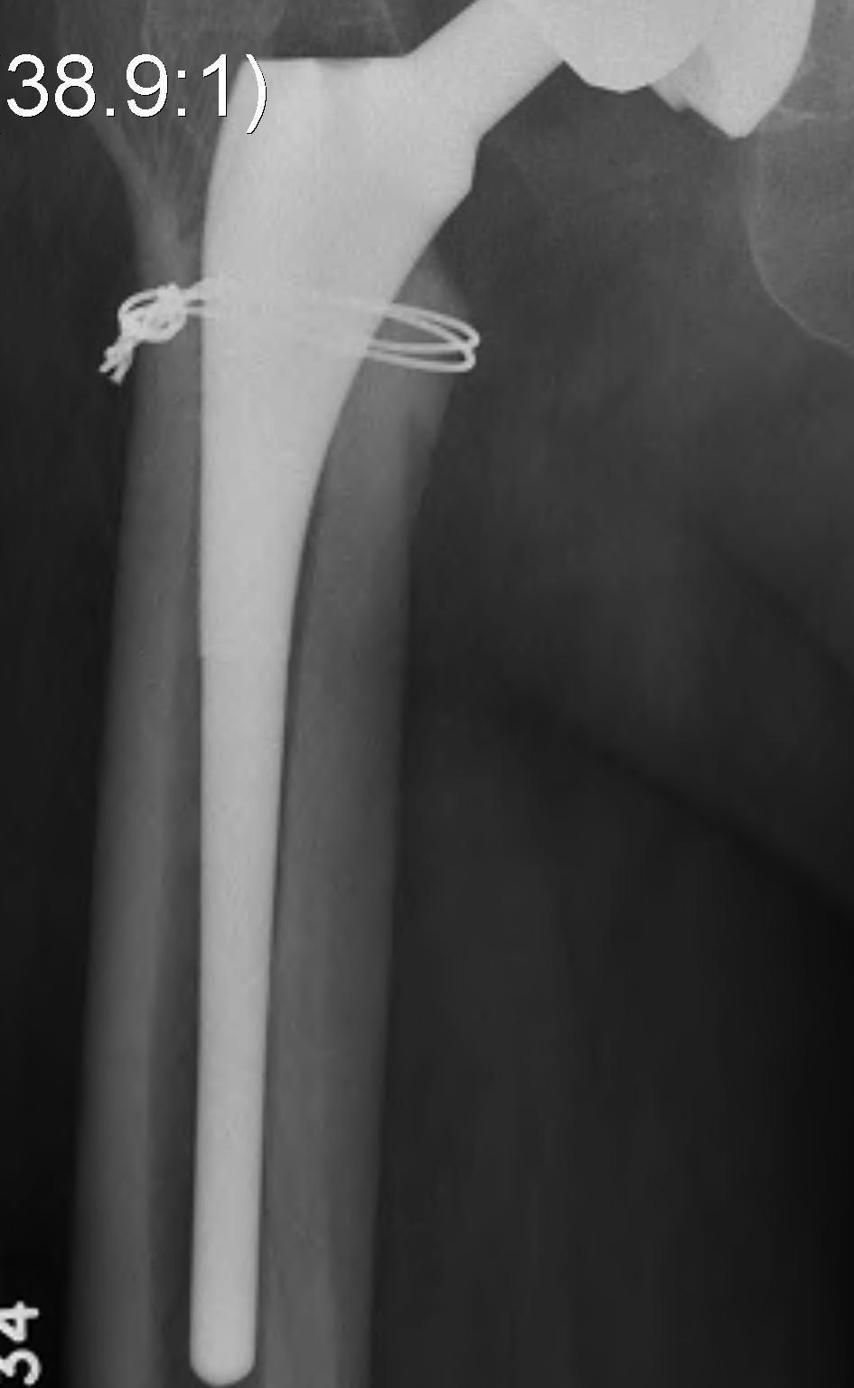 Uncement Femur Intraoperative Fracture